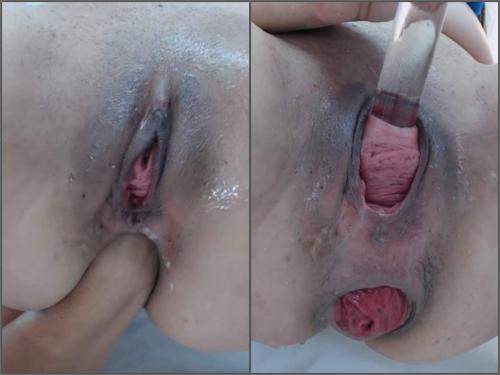 Cervix Prolapse Porn - Webcam latina Carolinauribe cervix stretching and loose prolapse anal  hardcore â€“ prolapse ass, Latina download free fisting at our extreme porn  hub